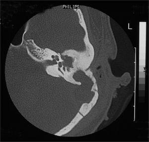 Sigmoid Sinus Thrombosis Associated To Chronic Otitis Media 