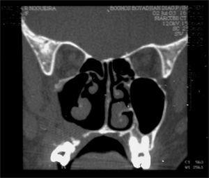 Rare nasosinusal tumors: Case series and literature review | Brazilian ...