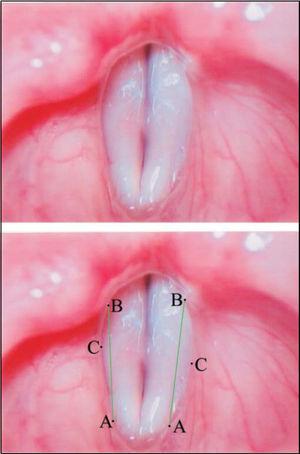 Superior – Laryngeal telelaryngoscopic image of female gender during emission of vowel/e/with minor stria sulcus and Concave vestibular fold. Inferior – same image of points and reference arrows AB.