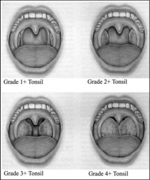 Grading of palatine tonsils hypertrophy proposed by L. Brodsky.
