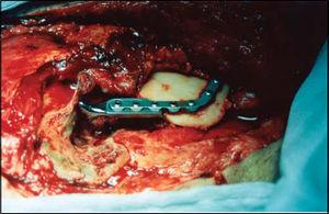 Intraoperative view. The metal condyle prosthesis for the mandible