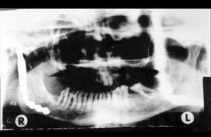 Panoramic X-ray, ten months postoperatively