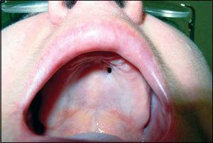 Oronasal fistula in the anterior region of hard palate on the left.