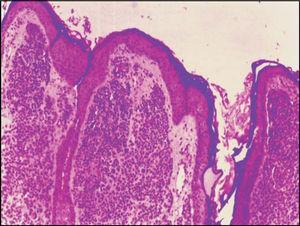 Histology section of melanocytic nevus - HE – 100 x.