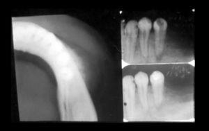 Occlusal radiographic view showing the external cortical portion with radiopacity similar to “sunrays” (on the left). Periapical X-rays showing increased periapical space of the premolar tooth (on the right).