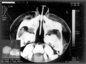 Axial section showing nasal fossa stenosis.