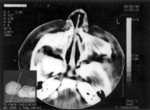 Pyriform aperture stenosis.