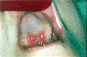 Aphthous lesions affecting the hard palate and jugal mucosa.