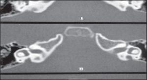 Audiometry showing bilateral mixed hearing loss.