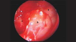 a: Posterior wall of maxillary antrum. b: Cyst capsule. c: Inner portion of cyst.