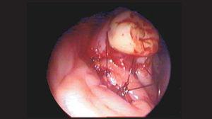 Oral aspect of mucous flap rotation over the oroantral fistula.