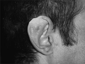 Partial reconstruction of the external ear after a trauma-simple and ...