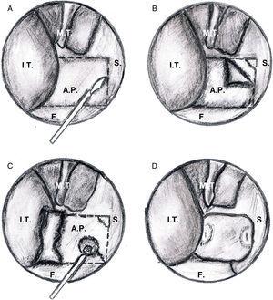 Surgical treatment of choanal atresia with transnasal endoscopic ...