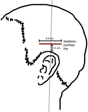 Effectiveness of acupuncture therapy as treatment for tinnitus: a ...