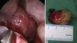 (A) Bleeding mass in the nasal cavity. (B) Mass after endoscopic excision.