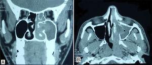 (A) Contrast enhanced computerized tomography – coronal view showing mass filling the left nasal cavity destroying the inferior and middle turbinates. (B) Contrast enhanced computerized tomography – axial view, showing destruction of inferior turbinate along its entire length.