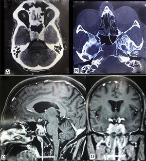 (A) Contrast enhanced computerized tomography axial view showing brilliantly enhancing mass involving the clivus. (B) Computerized tomography – axial view, bone window, showing osteolytic lesion of clivus. (C) Magnetic resonance imaging – sagittal view showing clival lesion with hypoechoic area. (D) Magnetic resonance imaging – coronal view.
