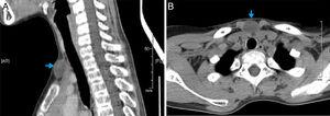 (A) CT neck sagittal showing the cyst (blue arrow) in the suprasternal area. (B) Axial contrasted CT scan of neck showing the cyst and its relation to the surrounding structure.