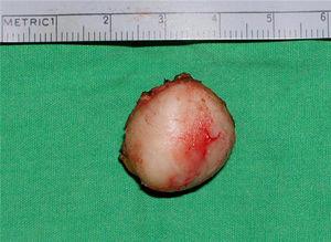 Intact epidermoid cyst after excision.