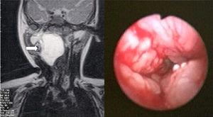 Magnetic resonance imaging, showing lesion in the retropharynx to the right (arrow). Endoscopic image of the upper airway (picture on the right).