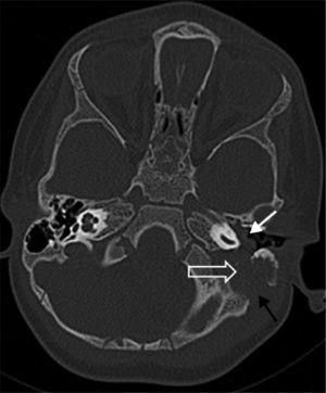 Axial computed tomography image at bone window shows a mass (open arrow) within the left mastoid air cells with an extension into the middle ear cavity (white arrow). Note the associated cortical erosion at the mastoid bone (black arrow).
