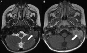 Axial T2-weighted magnetic resonance image (A) demonstrates a hypointense mass (arrow) occupying the left mastoid cavity. Postcontrast T1-weighted image; (B) reveals homogeneous enhancement within the mass (arrow).