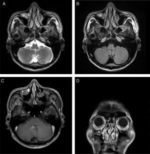 Brain MRI showed a fluid-filled Haller's cell (*) in the roof of the right maxillary sinus that was hyperintense on T2 axial image (A) and T2 FLAIR image (B). It was isointense on T1-weighted axial image (C) with subtle postcontrast enhancement (D).