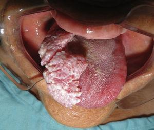 Warty aspect of the lesion on the dorsum and lateral border of the tongue.