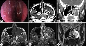Preoperative endoscopic and radiologic findings. Nasal endoscopy (A) shows bulging of left Lateral Nasal Wall (LNW). Axial (B) and coronal (B) computed tomographic images shows heterogenous enhancing mass in left maxillary sinus without adjacent bony involvement. The mass shows mixed high signal intensity on T1 axial (D), avid enhancement on postcontrast T1 axial (E), and heterogenous high signal intensity on T2 coronal (F) magnetic resonance images. S, nasal septum.