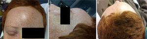(a–c) Physical findings at admission in our hospital: right frontal swelling, with redness and fluctuation; and right periorbital celulitis.