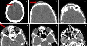 CT scan of brain, orbits and paranasal sinuses. (a) subdural and inter-hemyspheric empyema; (b) frontal subcutaneous abscess; (c) frontal sinusitis; (d–e) right orbital abscess and ethmoidal sinusitis; (f) maxillary sinusitis.