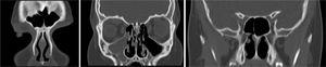 CT scan of paranasal sinuses (post-operative) showing only opacity of right maxillary sinus.
