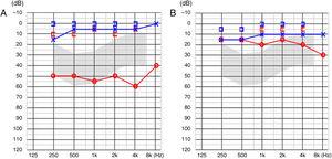 (A) Preoperative PTA showed 54dB conductive hearing loss. (B) Postoperative PTA revealed reduced air–bone gap.