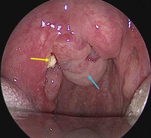 A lobulated mass was actually a huge encapsulated right peritonsillolith (blue arrow) with extension to the right peritonsillar space and small yellowish tonsillolith (yellow arrow) on the upper pole of right tonsil.