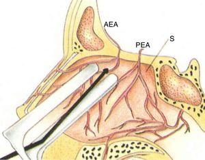 Microscopic cauterization of the branches of the anterior ethmoidal artery (AEA, anterior ethmoidal artery; PEA, posterior ethmoidal artery; S, septum).