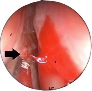 Left nasal cavity, upper endoscopic view, above the axilla of the middle turbinate (A). The S-point (black arrow) is a vascular pedicle in the upper portion of the nasal septum (S). Note that the blood pulsation can be strong enough to reach the lateral nasal wall, with a posterior flow, simulating posterior epistaxis (MT, middle turbinate).