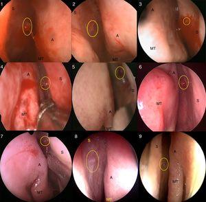 Identification of the S-point in nine cases (1–9). The S-point was identified with a yellow circle (S, nasal septum; A, axilla of the middle turbinate; MT, middle turbinate).