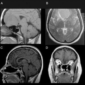 Endoscopic endonasal double flap technique for reconstruction of large ...