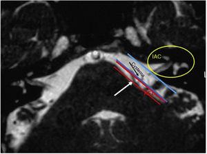 T2 weighted MRI showing the boundaries of the root entry zone (REZ) in the cerebellopontine angle and the internal auditory canal (IAC). Notice the conflict between the vessel (white arrow) and the facial nerve (black arrow) at the REZ.