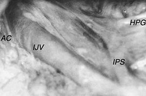 Right inferior petrosal sinus (IPS) in the neck, accessory nerve (AC) crossing in front of the internal jugular vein (IJV). HPG, hypoglossal nerve.