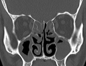 Comparison of natural ostiodilatation and endoscopic sinus surgery in ...