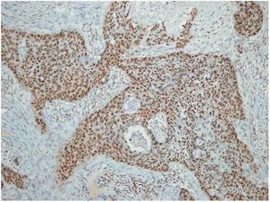 Metastatic squamous cell carcinoma; positive nuclear CSE1L staining.