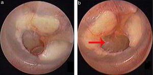 The spontaneous healing of traumatic TMP: 3 days after perforation (a), atrophic healing (b). Red arrows indicated atrophic eardrum.