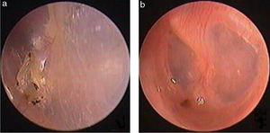 The pseudo healing of traumatic TMP and EGF treatment: the pseudo healing of eardrum within 2 months after perforation, thickened tawny tissue and a punctate perforation were seen (a); one week after EGF treatment (b).