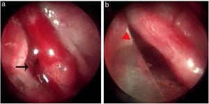 Bleeding point on the upper nasal septum. (a) Bleeding point; (b) The MWA zone. Black arrows, bleeding point; red triangle, ablation zone.