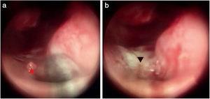 Bleeding point on the bottom of the common nasal meatus. (a) Bleeding point; (b) The MWA zone. Red triangle, bleeding point; black triangle, ablation zone.