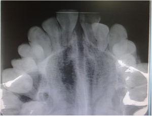 Occlusal view radiograph showing fan-shaped opening of the midpalatal suture in the same patient.