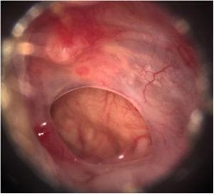 Preoperative otoscopy: central perforations of the tympanic membrane, healthy tympanic cavity mucosa and absence of suppuration.