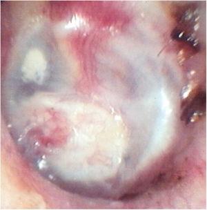 Otoendoscopy in the 6th postoperative month: intact neotympanum after cartilage graft adhesion.