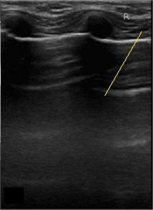 False positive non-malignant nodules by ultrasound. 68 years woman with papillary thyroid carcinoma diagnosed by tumor histological data. Transverse ultrasound image of the right thyroid lobe. Arrow indicates hypoechoic mass.